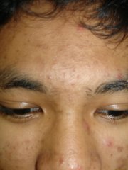 smoking_and_acne